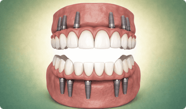 Advances-Full-arch-restoration-Per-arch (1)