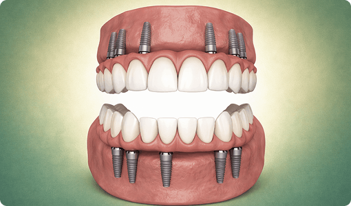 Advances Full arch restoration Per arch