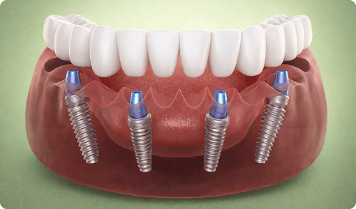 All‑on‑4® Full‑Arch Implants Per arch