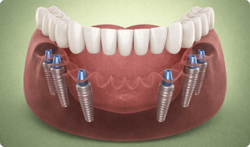 All‑on‑6®-Full‑Arch-Implants-Per-arch (1)