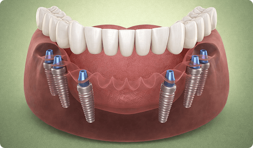 All‑on‑6® Full‑Arch Implants Per arch