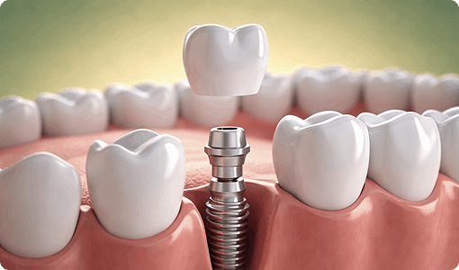 Implant‑Supported Crown