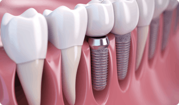 Multiple-Implants (1)